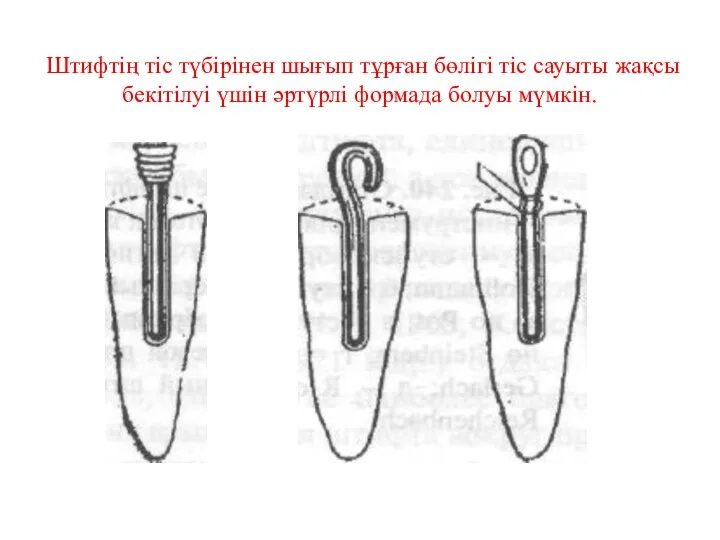 Штифтің тіс түбірінен шығып тұрған бөлігі тіс сауыты жақсы бекітілуі үшін әртүрлі формада болуы мүмкін.