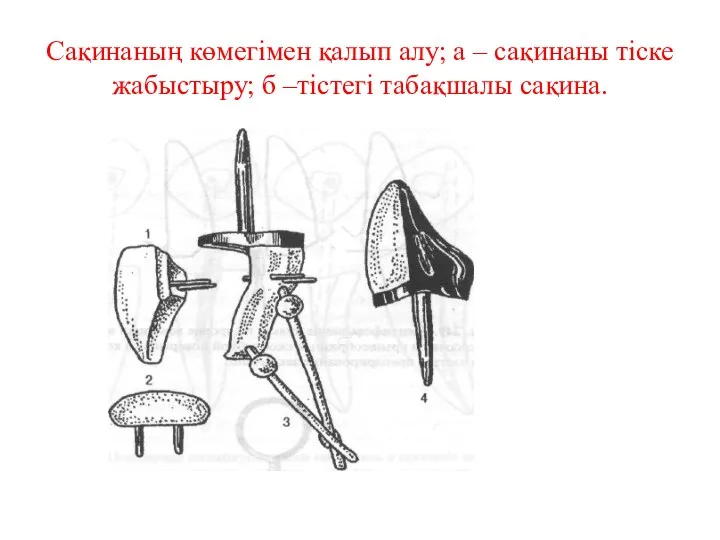 Сақинаның көмегімен қалып алу; а – сақинаны тіске жабыстыру; б –тістегі табақшалы сақина.