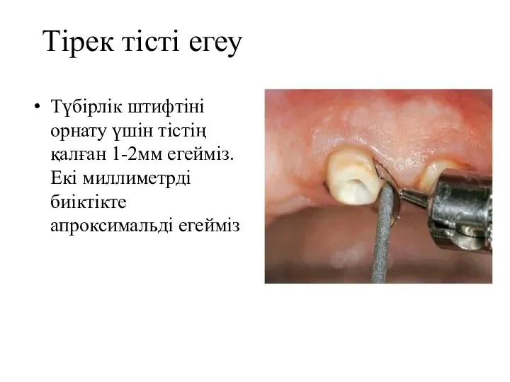 Тірек тісті егеу Түбірлік штифтіні орнату үшін тістің қалған 1-2мм егейміз. Екі миллиметрді биіктікте апроксимальді егейміз