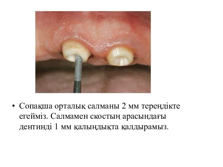 Сопақша орталық салманы 2 мм тереңдікте егейміз. Салмамен скостың арасындағы дентинді 1 мм қалыңдықта қалдырамыз.