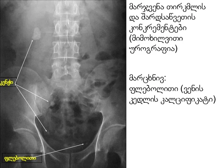 კენჭი ფლებოლითი მარჯვენა თირკმლის და შარდსაწვეთის კონკრემენტები (მიმოხილვითი უროგრაფია) მარცხნივ: ფლებოლითი (ვენის კედლის კალციფიკატი)
