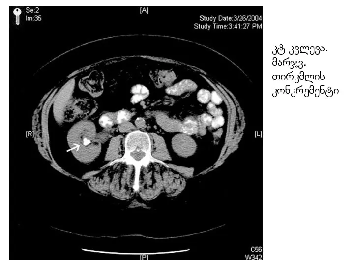 კტ კვლევა. მარჯვ. თირკმლის კონკრემენტი