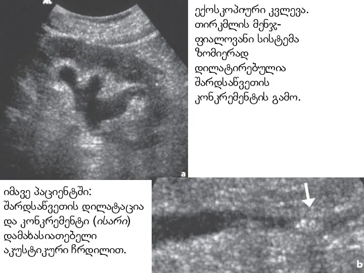 ექოსკოპიური კვლევა. თირკმლის მენჯ-ფიალოვანი სისტემა ზომიერად დილატირებულია შარდსაწვეთის კონკრემენტის გამო.