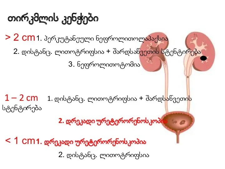 > 2 cm 1. პერკუტანეული ნეფროლითოლაპაქსია 2. დისტანც. ლითოტრიფსია +