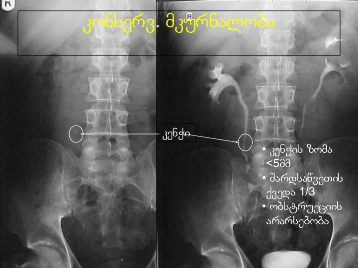 კენჭი კონსერვ. მკურნალობა კენჭის ზომა შარდსაწვეთის ქვედა 1/3 ობსტრუქციის არარსებობა