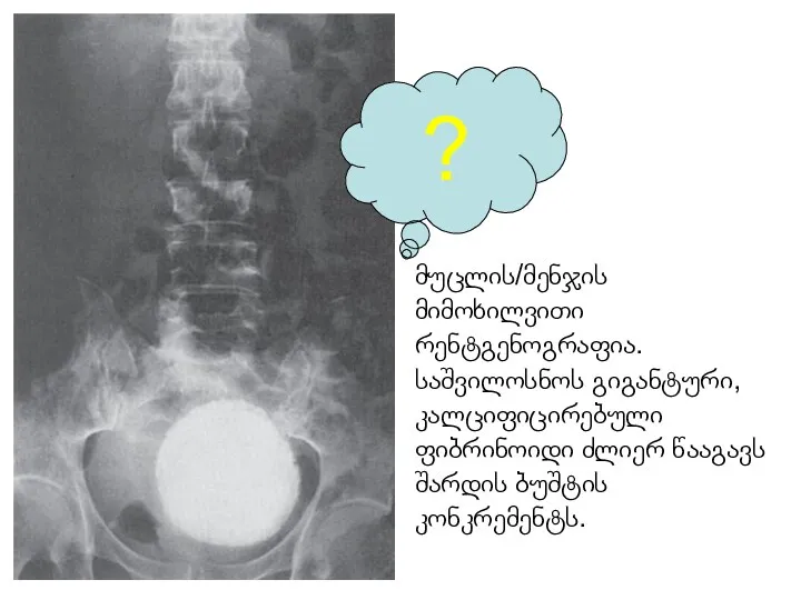 ? მუცლის/მენჯის მიმოხილვითი რენტგენოგრაფია. საშვილოსნოს გიგანტური, კალციფიცირებული ფიბრინოიდი ძლიერ წააგავს შარდის ბუშტის კონკრემენტს.