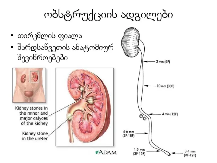 ობსტრუქციის ადგილები თირკმლის ფიალა შარდსაწვეთის ანატომიური შევიწროებები