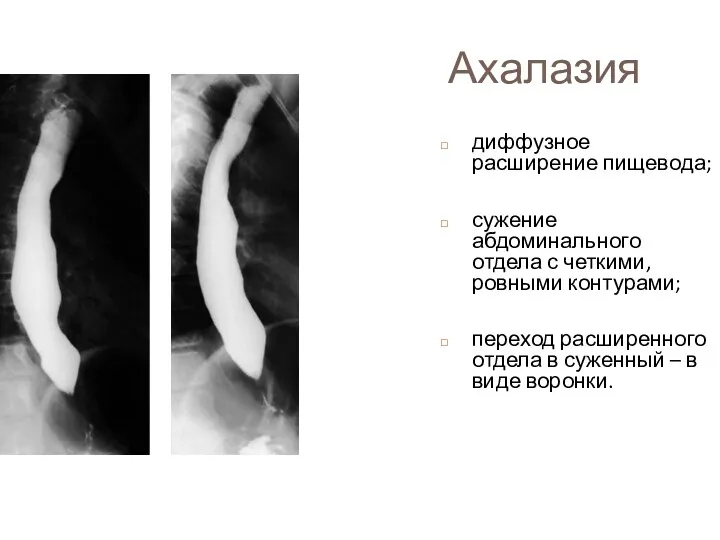 Ахалазия диффузное расширение пищевода; сужение абдоминального отдела с четкими, ровными