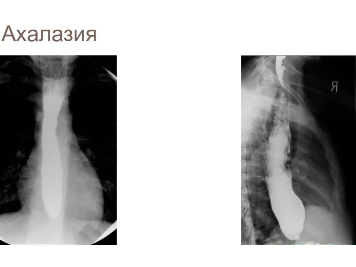 Ахалазия