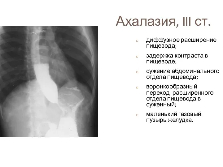 Ахалазия, III ст. диффузное расширение пищевода; задержка контраста в пищеводе;