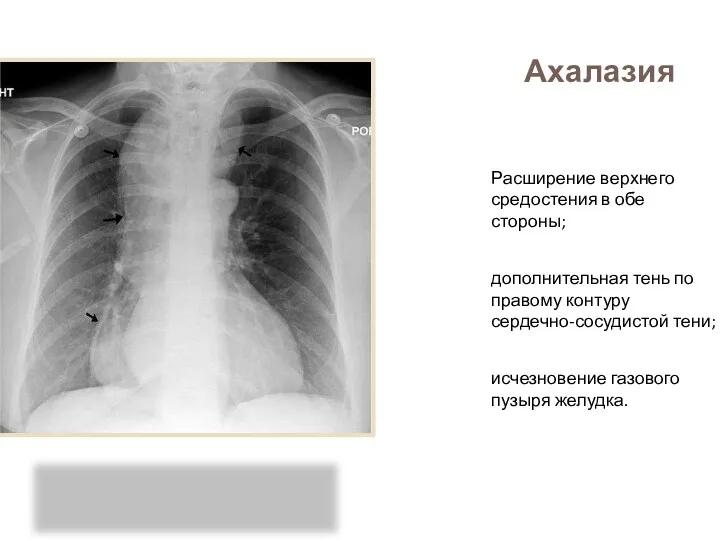 Ахалазия Расширение верхнего средостения в обе стороны; дополнительная тень по