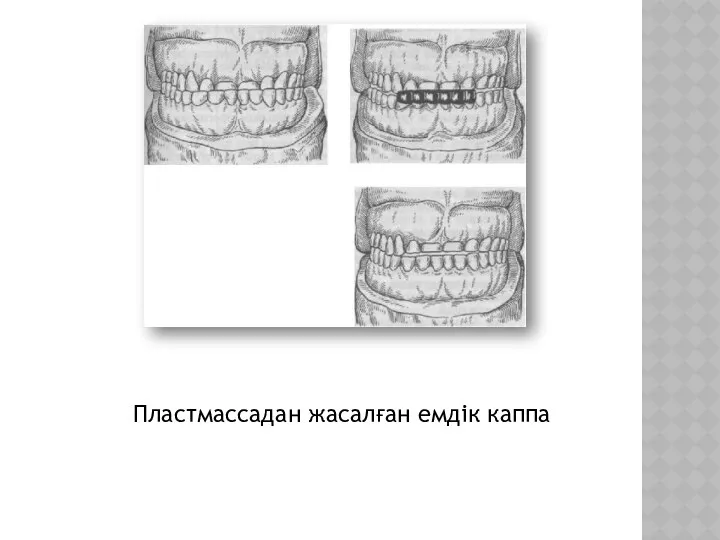 Пластмассадан жасалған емдік каппа