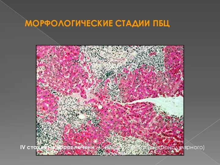 МОРФОЛОГИЧЕСКИЕ СТАДИИ ПБЦ IV стадия – цирроз печени монолобулярного (микронодулярного) строения