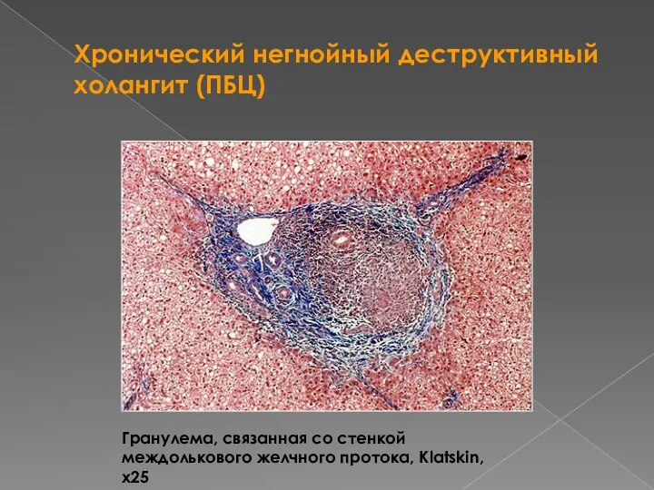 Хронический негнойный деструктивный холангит (ПБЦ) Гранулема, связанная со стенкой междолькового желчного протока, Klatskin, х25