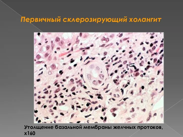 Первичный склерозирующий холангит Утолщение базальной мембраны желчных протоков, х160