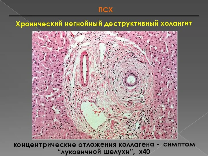 Хронический негнойный деструктивный холангит ПСХ концентрические отложения коллагена - симптом “луковичной шелухи”, х40