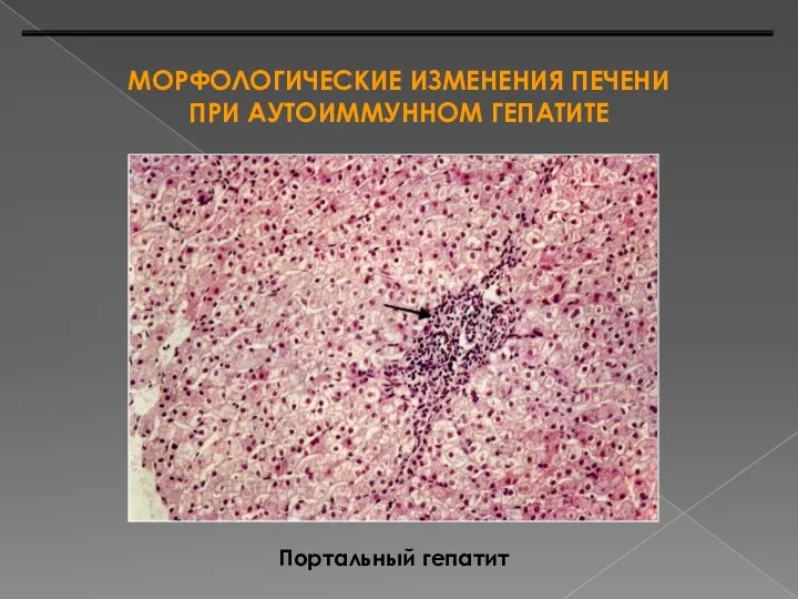 МОРФОЛОГИЧЕСКИЕ ИЗМЕНЕНИЯ ПЕЧЕНИ ПРИ АУТОИММУННОМ ГЕПАТИТЕ Портальный гепатит