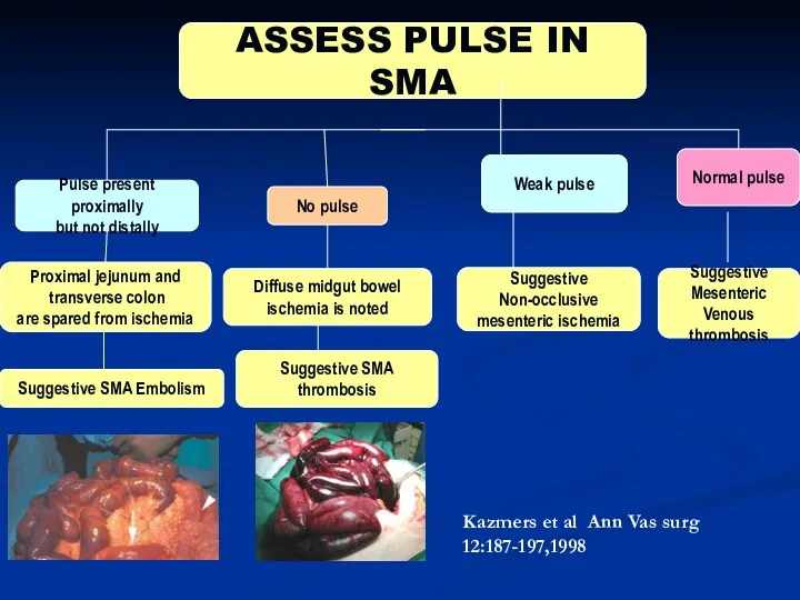 ASSESS PULSE IN SMA Weak pulse Normal pulse Proximal jejunum and transverse colon