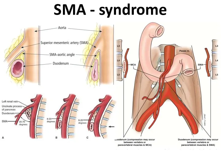 SMA - syndrome