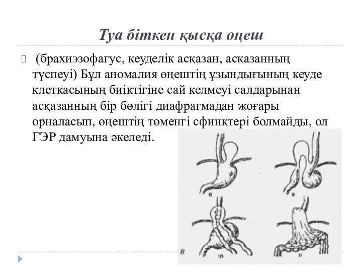 Туа біткен қысқа өңеш (брахиэзофагус, кеуделік асқазан, асқазанның түспеуі) Бұл