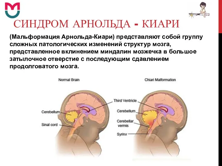 СИНДРОМ АРНОЛЬДА - КИАРИ (Мальформация Арнольда-Киари) представляют собой группу сложных