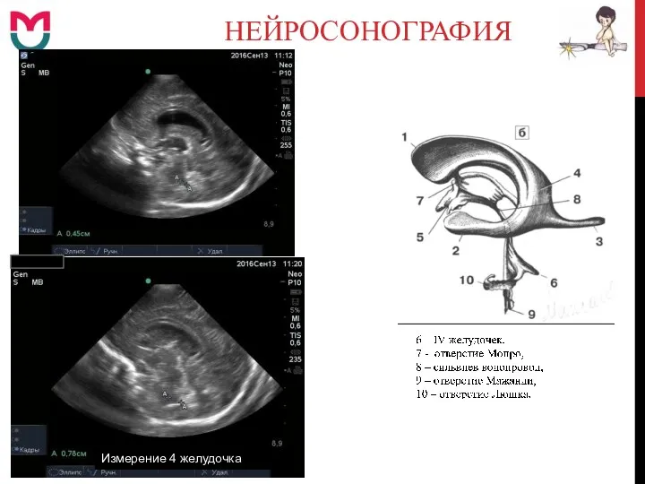 НЕЙРОСОНОГРАФИЯ