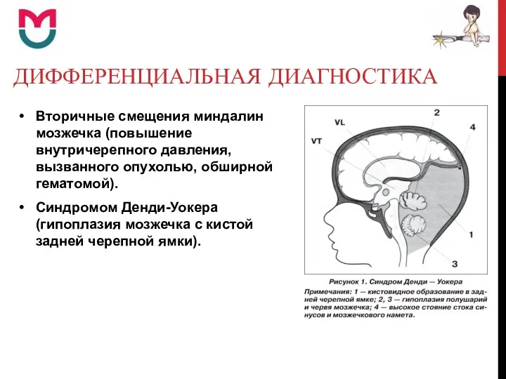 ДИФФЕРЕНЦИАЛЬНАЯ ДИАГНОСТИКА Вторичные смещения миндалин мозжечка (повышение внутричерепного давления, вызванного