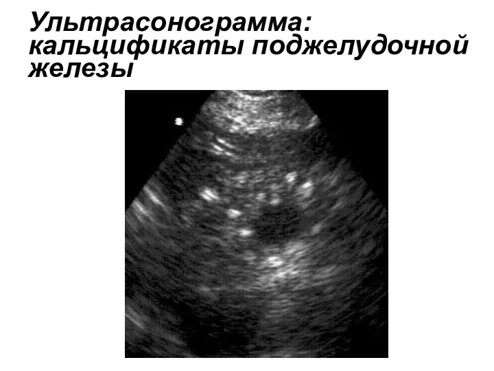 Ультрасонограмма: кальцификаты поджелудочной железы