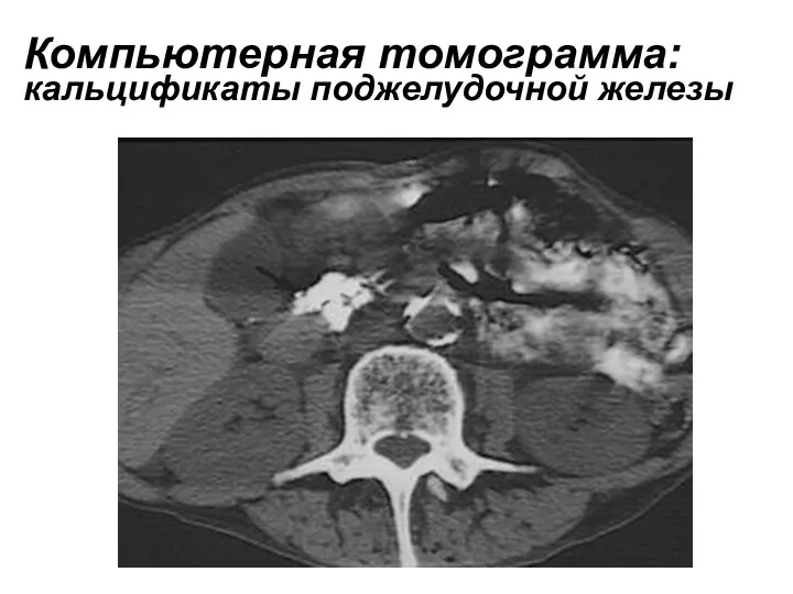 Компьютерная томограмма: кальцификаты поджелудочной железы