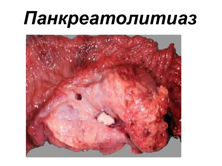 Панкреатолитиаз