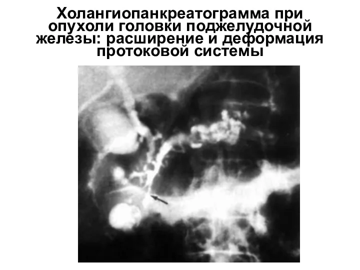 Холангиопанкреатограмма при опухоли головки поджелудочной железы: расширение и деформация протоковой системы