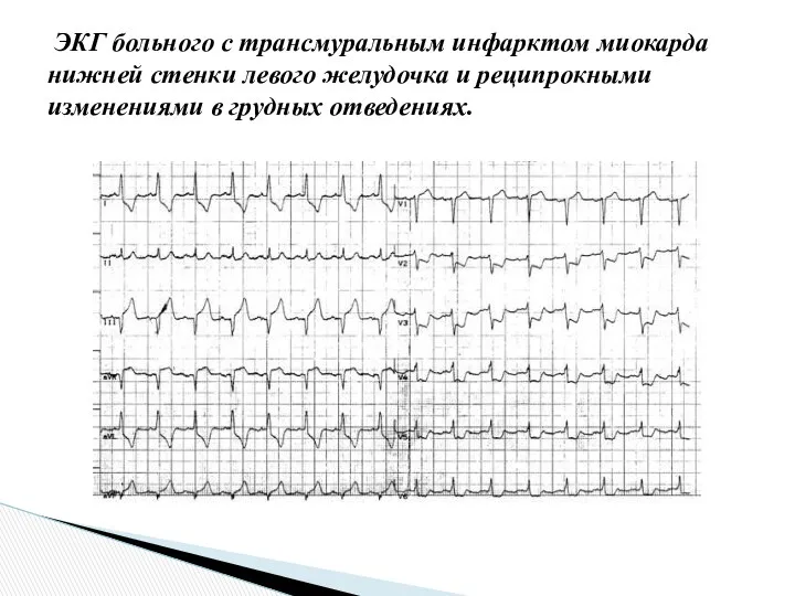 ЭКГ больного с трансмуральным инфарктом миокарда нижней стенки левого желудочка и реципрокными изменениями в грудных отведениях.