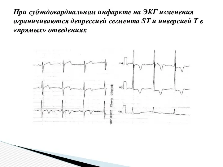 При субэндокардиальном инфаркте на ЭКГ изменения ограничиваются депрессией сегмента ST и инверсией Т в «прямых» отведениях