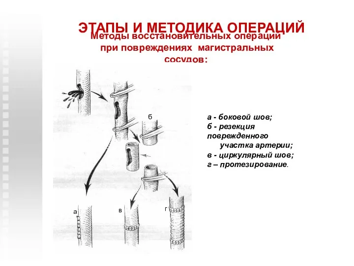 ЭТАПЫ И МЕТОДИКА ОПЕРАЦИЙ Методы восстановительных операций при повреждениях магистральных