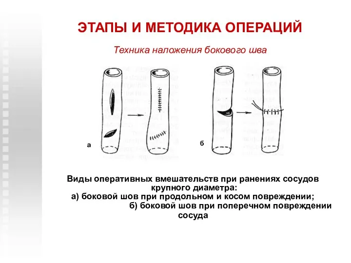 ЭТАПЫ И МЕТОДИКА ОПЕРАЦИЙ Виды оперативных вмешательств при ранениях сосудов