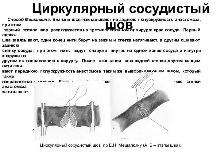 www.themegallery.com Циркулярный сосудистый шов Способ Мешалкина. Вначале шов накладывают на