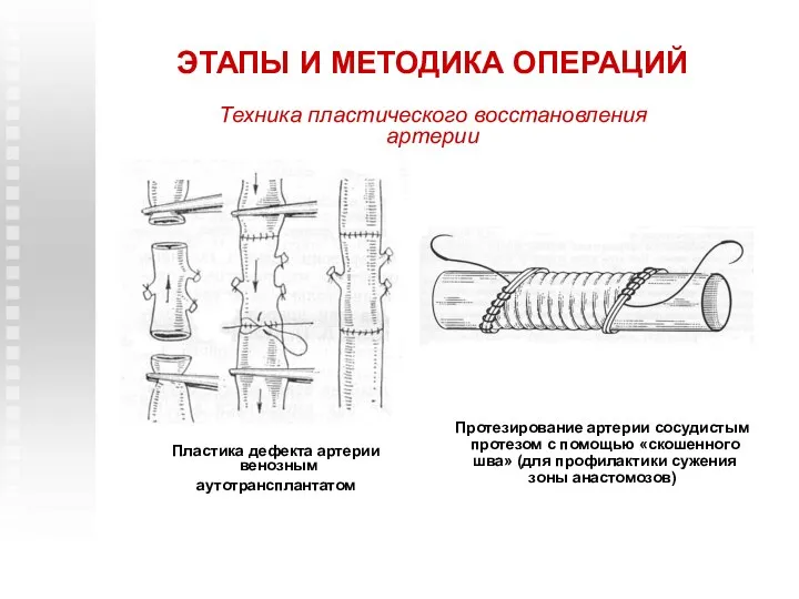 ЭТАПЫ И МЕТОДИКА ОПЕРАЦИЙ Техника пластического восстановления артерии Протезирование артерии