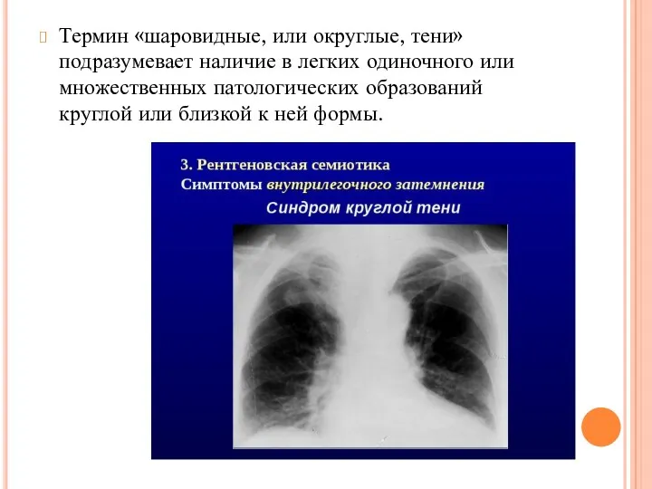 Термин «шаровидные, или округлые, тени» подразумевает наличие в легких одиночного или множественных патологических