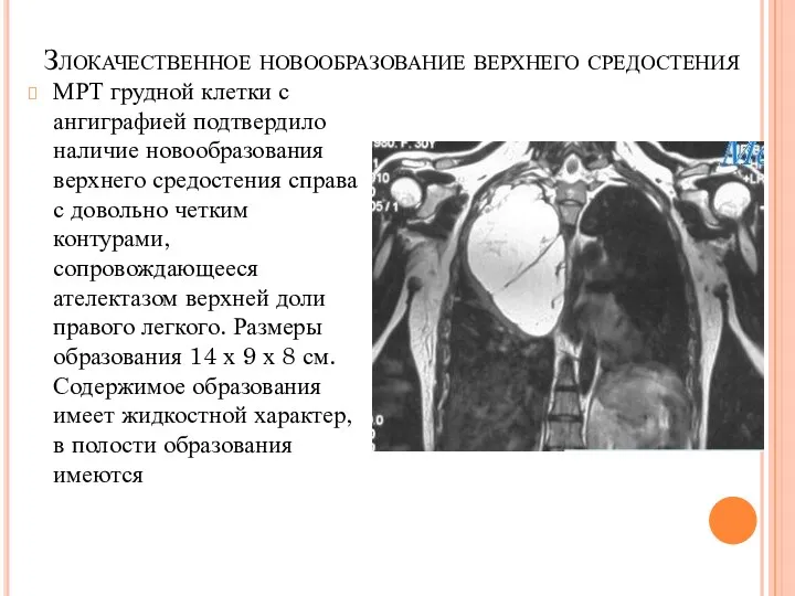 Злокачественное новообразование верхнего средостения МРТ грудной клетки с ангиграфией подтвердило наличие новообразования верхнего