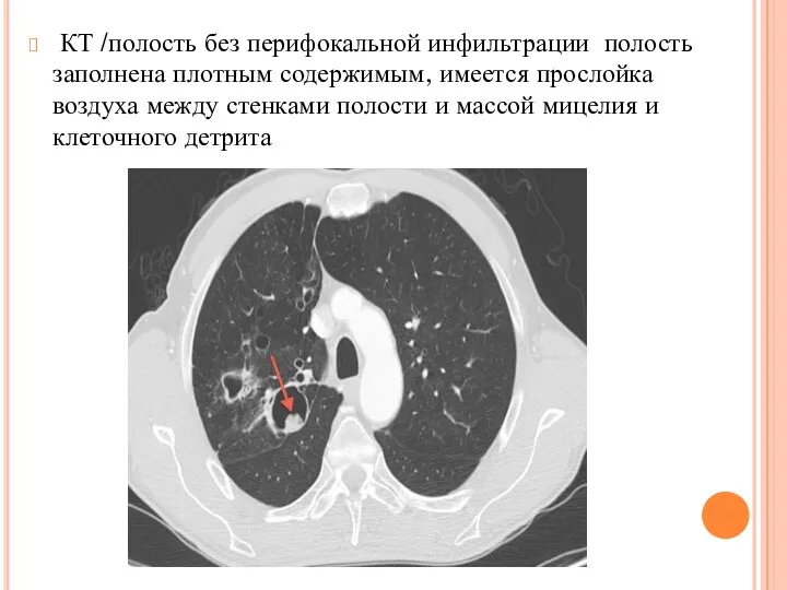 КТ /полость без перифокальной инфильтрации полость заполнена плотным содержимым, имеется прослойка воздуха между