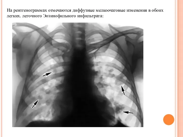 На рентгенограммах отмечаются диф­фузные мелкоочаговые изменения в обоих легких. легочного Эозинофильного инфильтрата:
