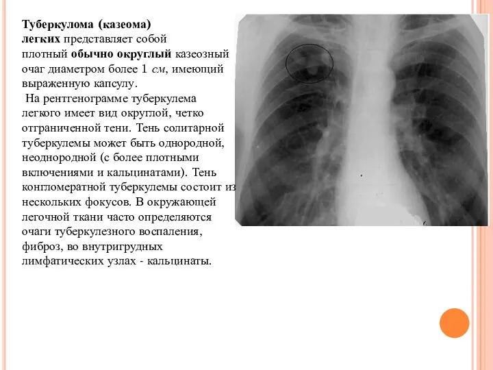 Туберкулома (казеома) легких представляет собой плотный обычно округлый казеозный очаг диаметром более 1