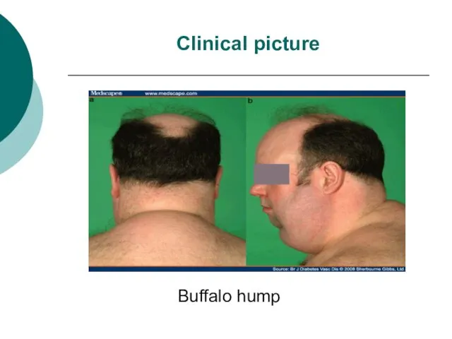 Clinical picture Buffalo hump