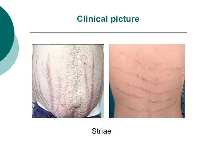 Clinical picture Striae