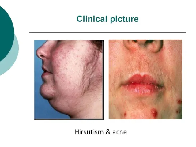 Clinical picture Hirsutism & acne