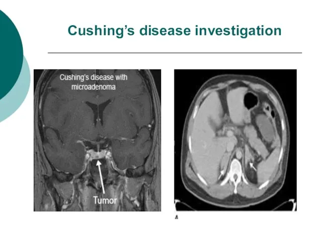 Cushing’s disease investigation