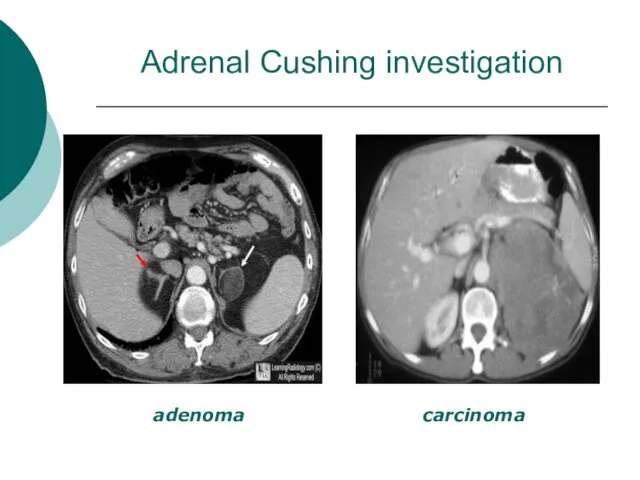 Adrenal Cushing investigation adenoma carcinoma