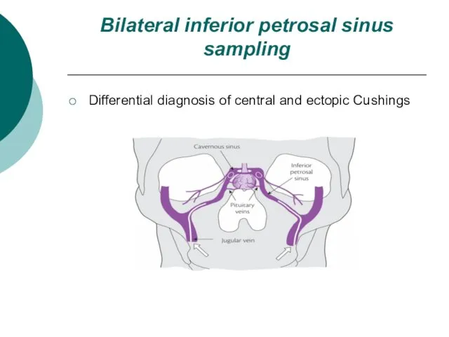 Bilateral inferior petrosal sinus sampling Differential diagnosis of central and ectopic Cushings