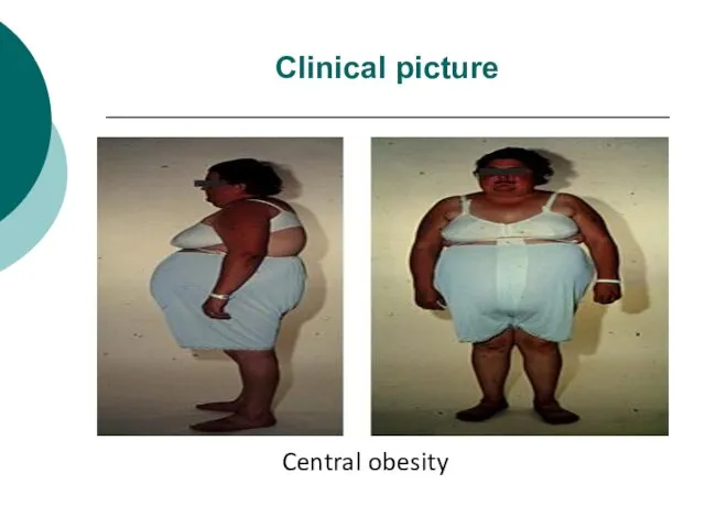 Clinical picture Central obesity