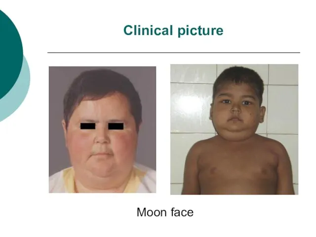 Clinical picture Moon face